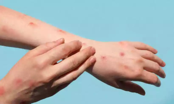 variola-do-macaco_iStock mpox